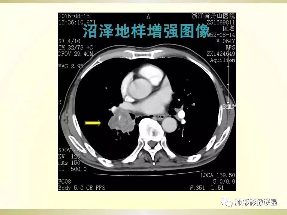 影像PPT - 【病例】精准打击—小细胞肺癌-41 影像PPT - 【病例】精准打击—小细胞肺癌-41