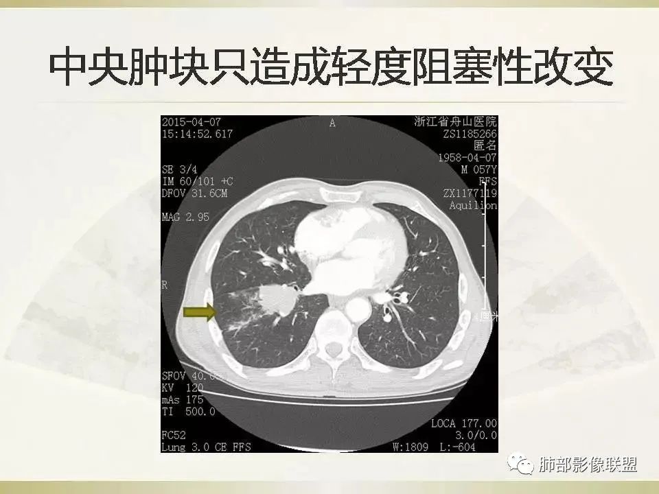影像PPT - 【病例】精准打击—小细胞肺癌-42 影像PPT - 【病例】精准打击—小细胞肺癌-42