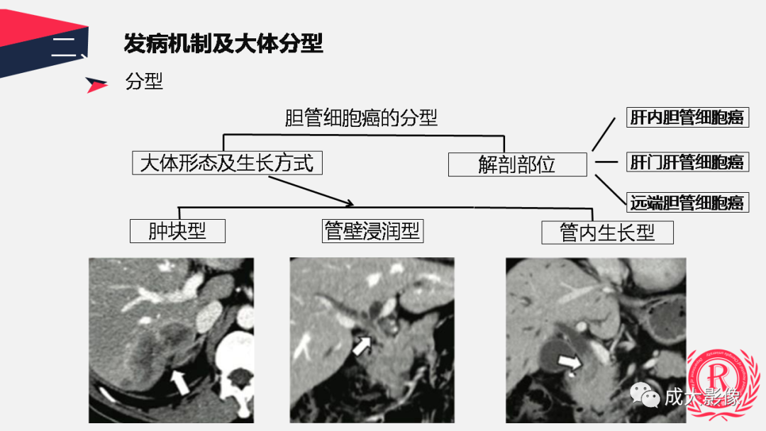 影像PPT - 【PPT】胆管细胞癌影像与临床-7