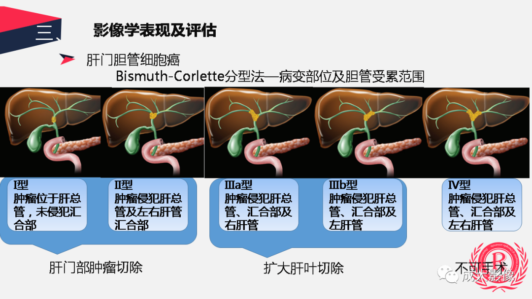 影像PPT - 【PPT】胆管细胞癌影像与临床-11