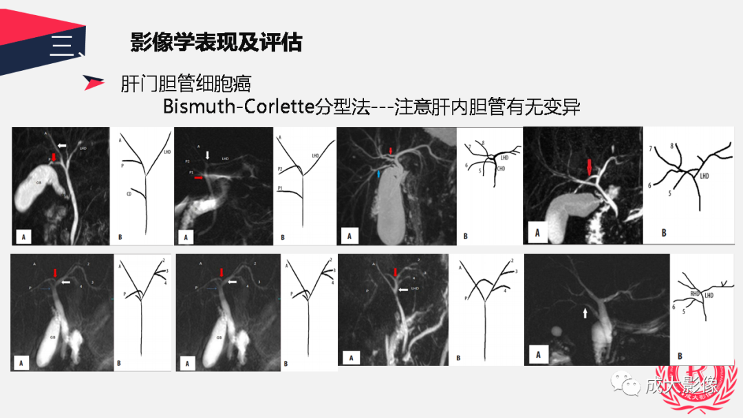 影像PPT - 【PPT】胆管细胞癌影像与临床-12