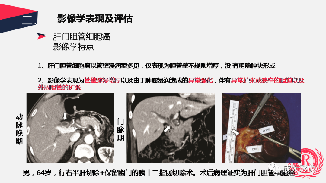 影像PPT - 【PPT】胆管细胞癌影像与临床-18