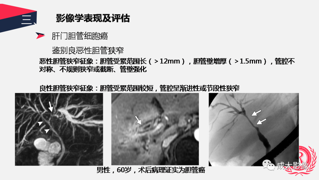 影像PPT - 【PPT】胆管细胞癌影像与临床-20