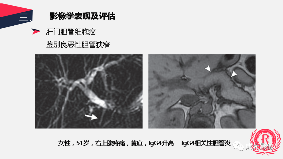 影像PPT - 【PPT】胆管细胞癌影像与临床-21