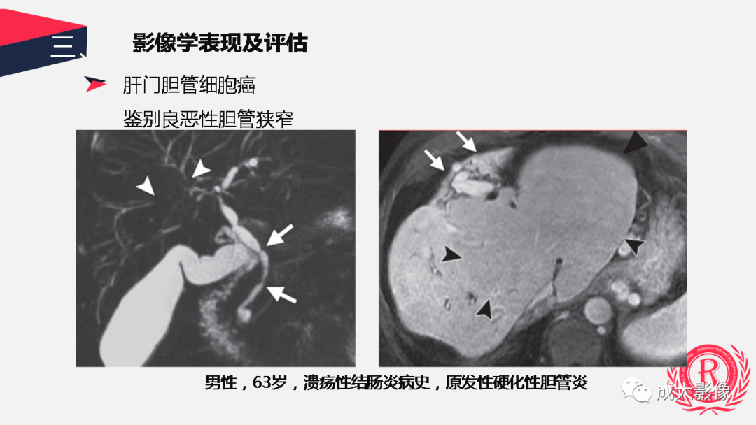 影像PPT - 【PPT】胆管细胞癌影像与临床-22