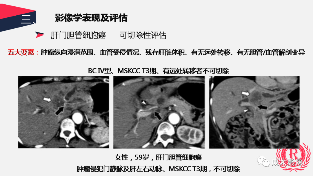 影像PPT - 【PPT】胆管细胞癌影像与临床-23