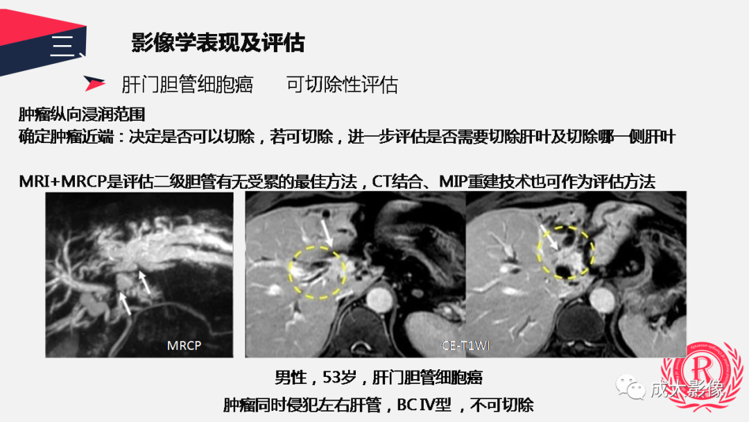 影像PPT - 【PPT】胆管细胞癌影像与临床-24