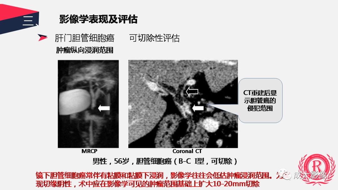 影像PPT - 【PPT】胆管细胞癌影像与临床-25