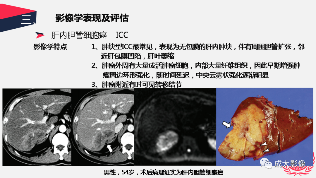 影像PPT - 【PPT】胆管细胞癌影像与临床-28