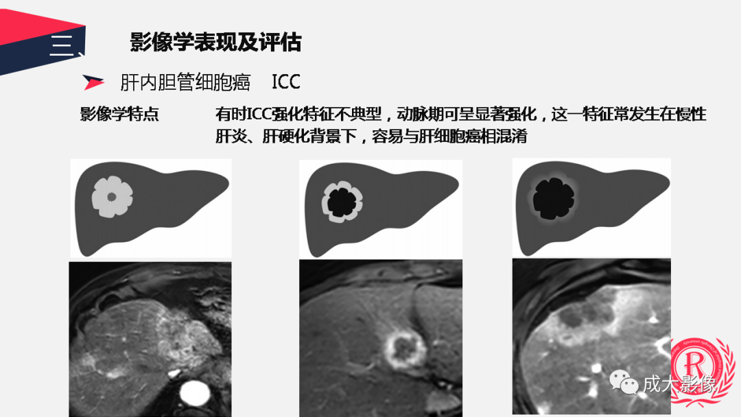 影像PPT - 【PPT】胆管细胞癌影像与临床-29