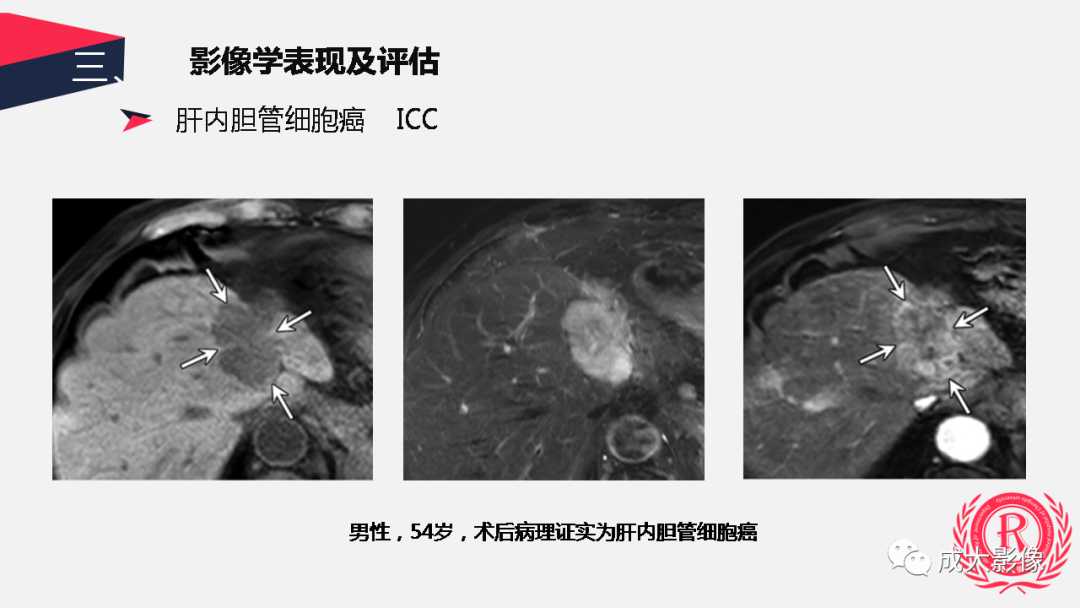 影像PPT - 【PPT】胆管细胞癌影像与临床-30