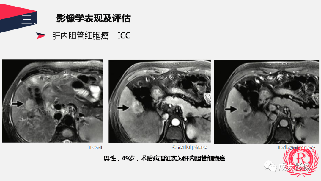 影像PPT - 【PPT】胆管细胞癌影像与临床-31