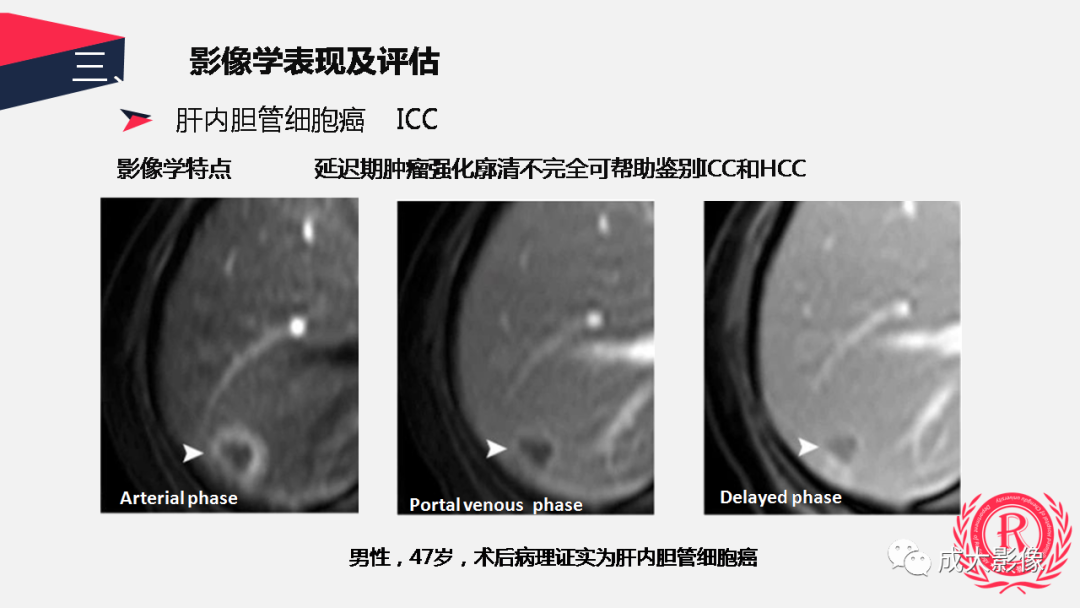 影像PPT - 【PPT】胆管细胞癌影像与临床-32