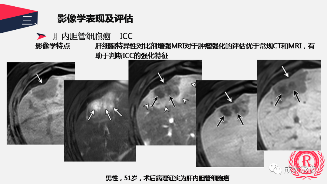影像PPT - 【PPT】胆管细胞癌影像与临床-33