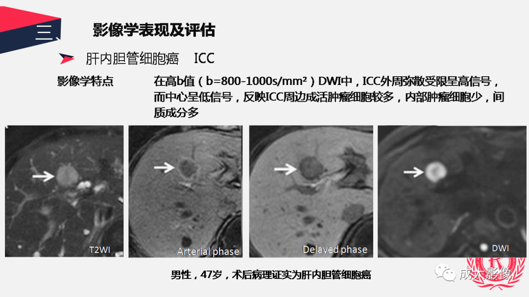 影像PPT - 【PPT】胆管细胞癌影像与临床-34