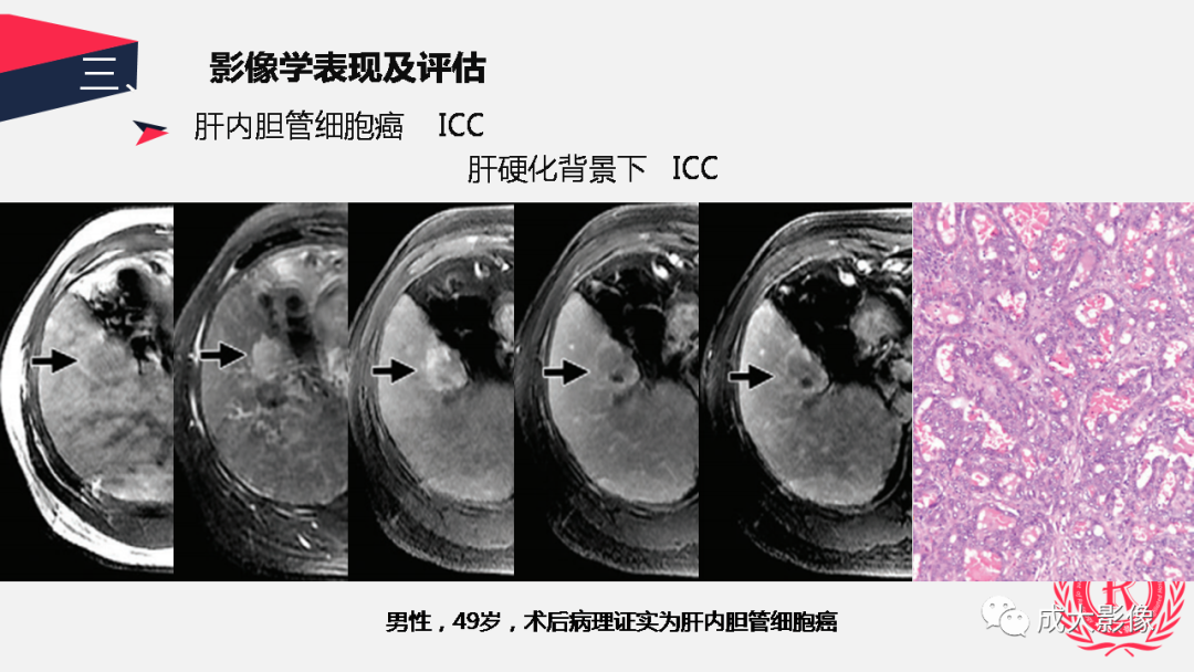 影像PPT - 【PPT】胆管细胞癌影像与临床-35