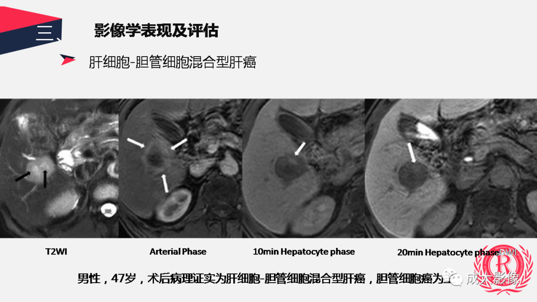 影像PPT - 【PPT】胆管细胞癌影像与临床-38