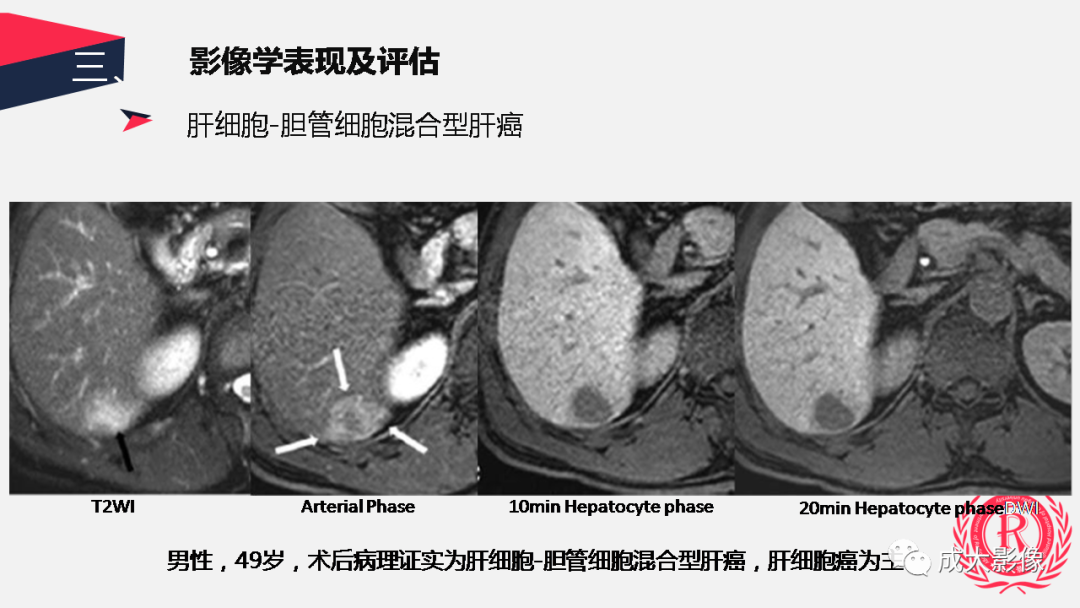 影像PPT - 【PPT】胆管细胞癌影像与临床-39