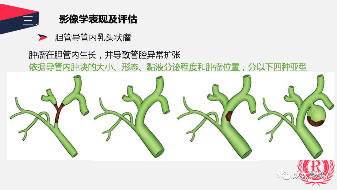 影像PPT - 【PPT】胆管细胞癌影像与临床-40