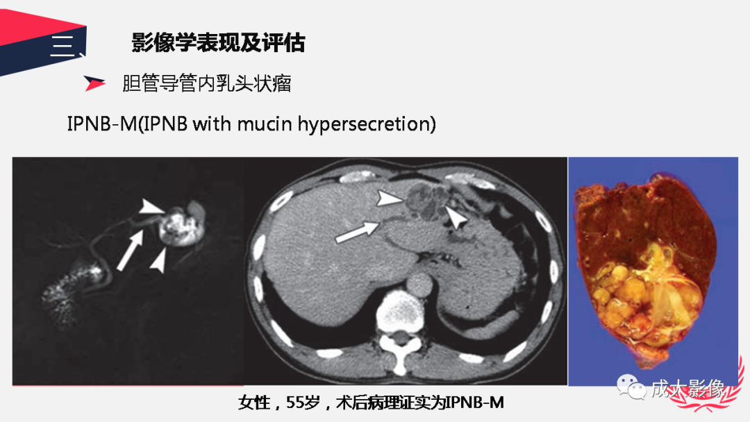 影像PPT - 【PPT】胆管细胞癌影像与临床-44