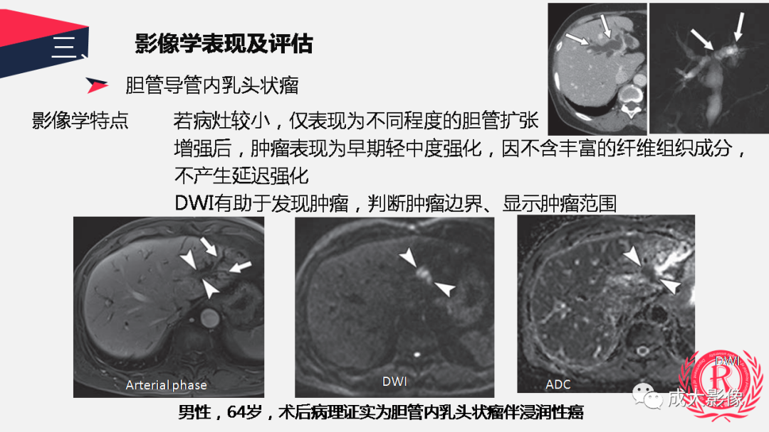 影像PPT - 【PPT】胆管细胞癌影像与临床-41