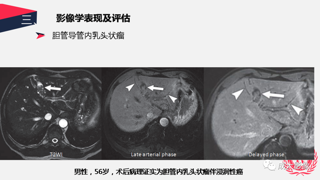 影像PPT - 【PPT】胆管细胞癌影像与临床-42