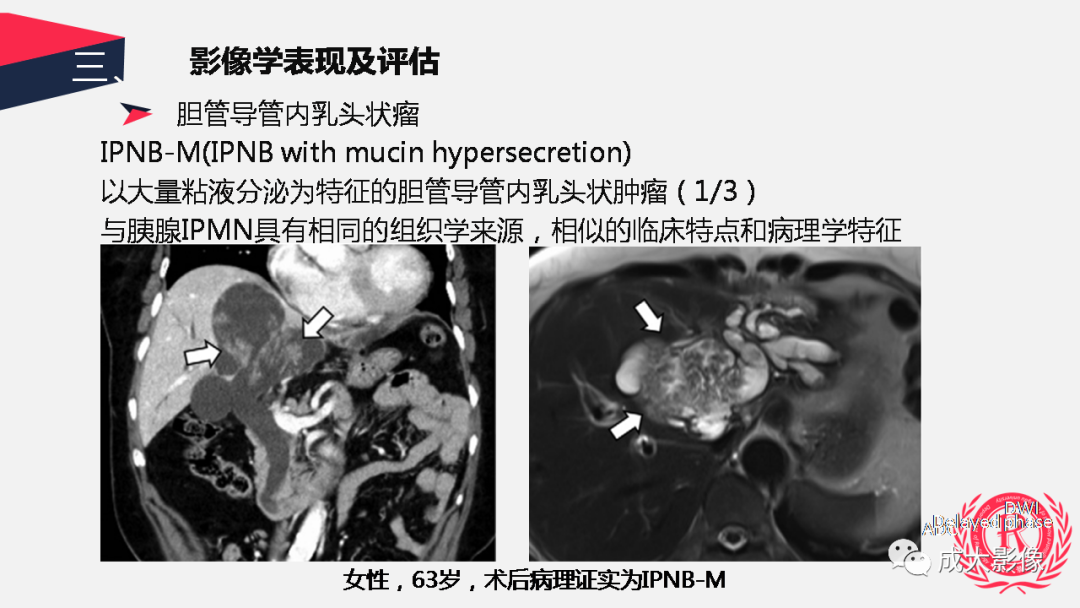 影像PPT - 【PPT】胆管细胞癌影像与临床-43