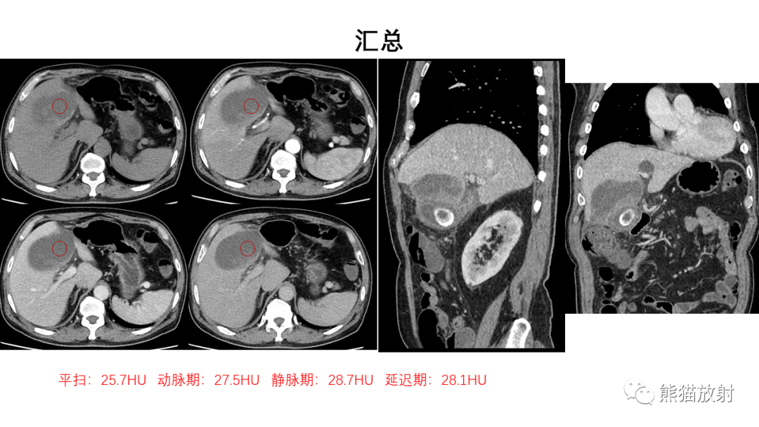 影像PPT - 【病例】肝内胆管细胞癌 VS 慢性炎性灶-35