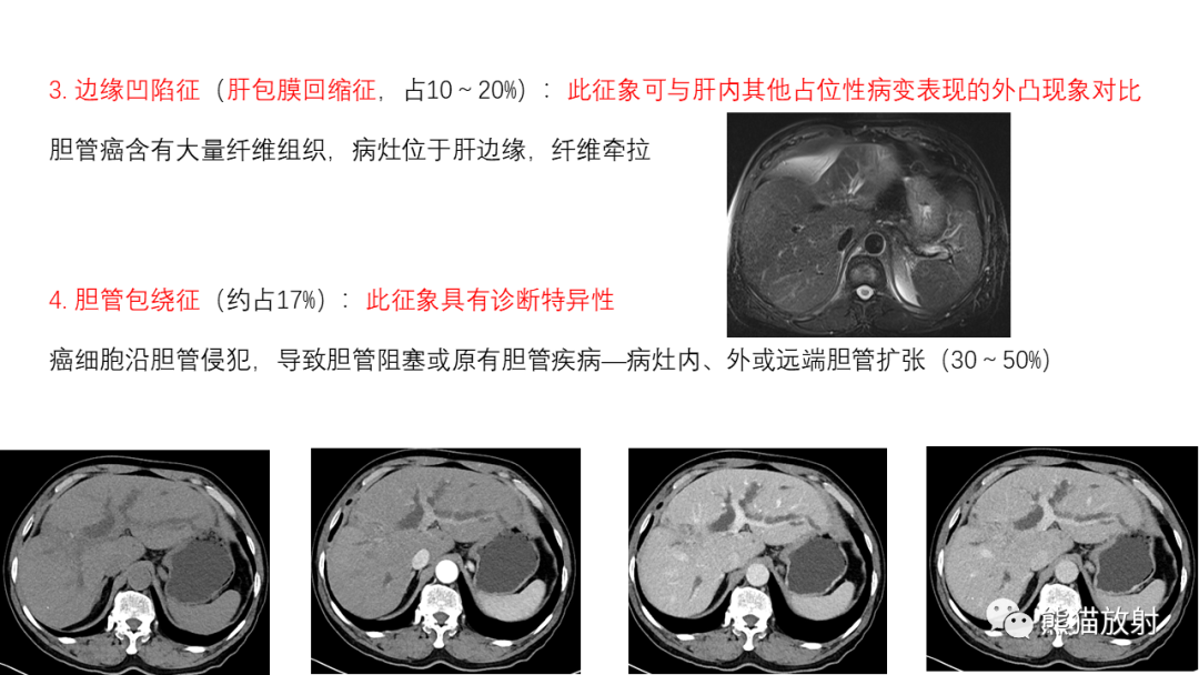 影像PPT - 【病例】肝内胆管细胞癌 VS 慢性炎性灶-43