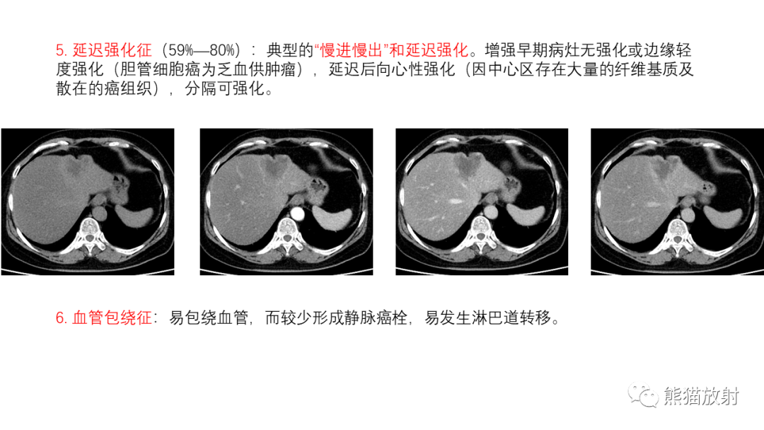 影像PPT - 【病例】肝内胆管细胞癌 VS 慢性炎性灶-44