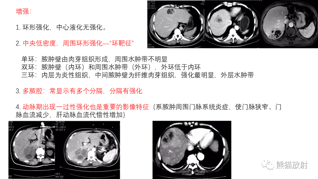 影像PPT - 【病例】肝内胆管细胞癌 VS 慢性炎性灶-47