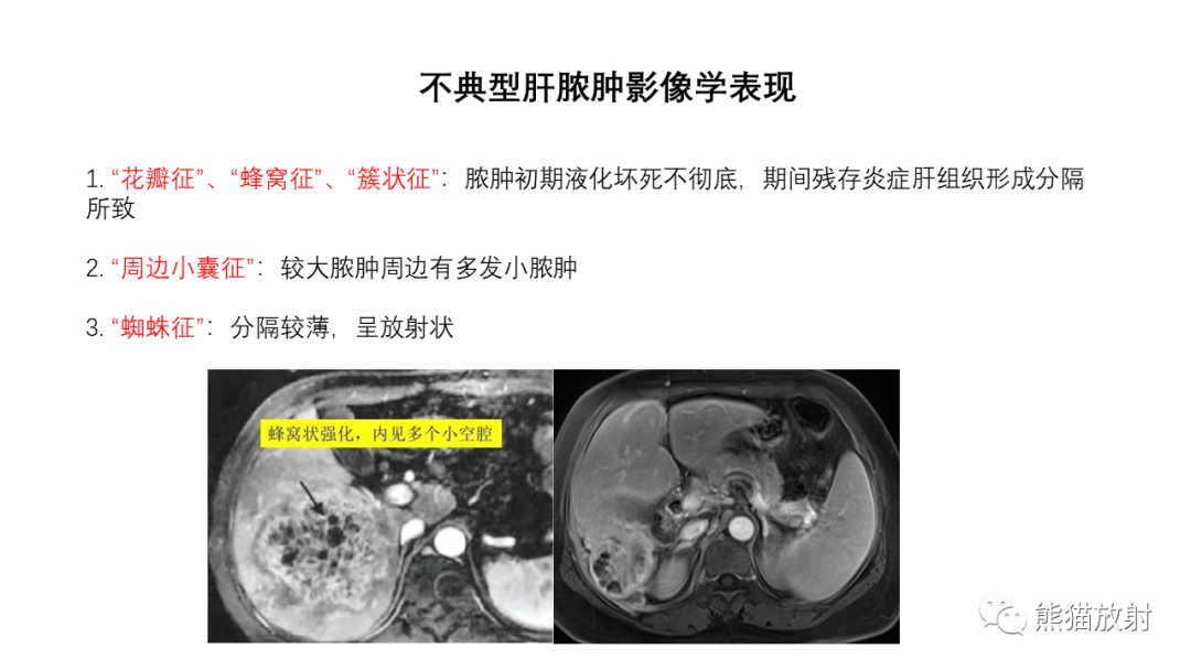 影像PPT - 【病例】肝内胆管细胞癌 VS 慢性炎性灶-49