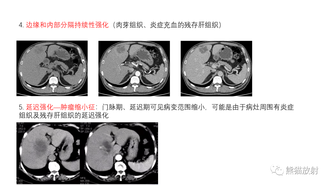 影像PPT - 【病例】肝内胆管细胞癌 VS 慢性炎性灶-50