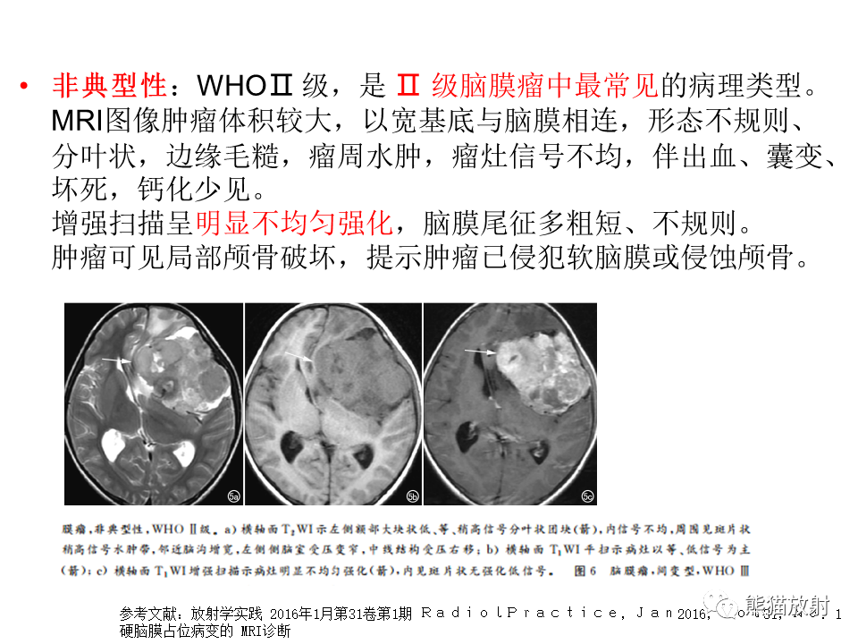 影像PPT - 【病例】脑膜瘤 VS 孤立性纤维瘤-40