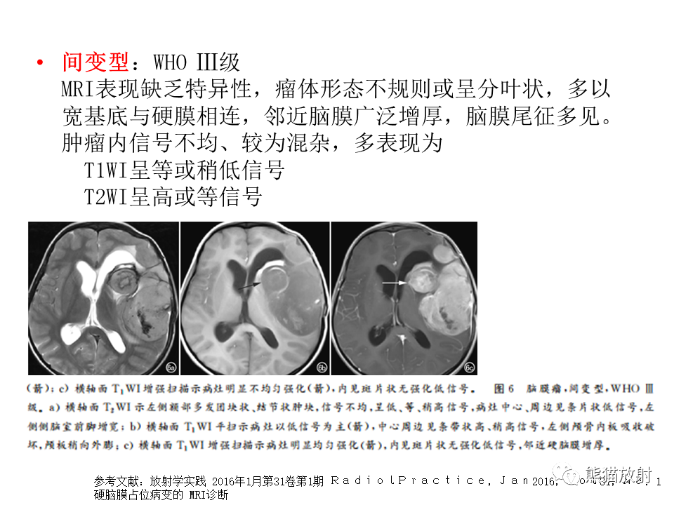 影像PPT - 【病例】脑膜瘤 VS 孤立性纤维瘤-41
