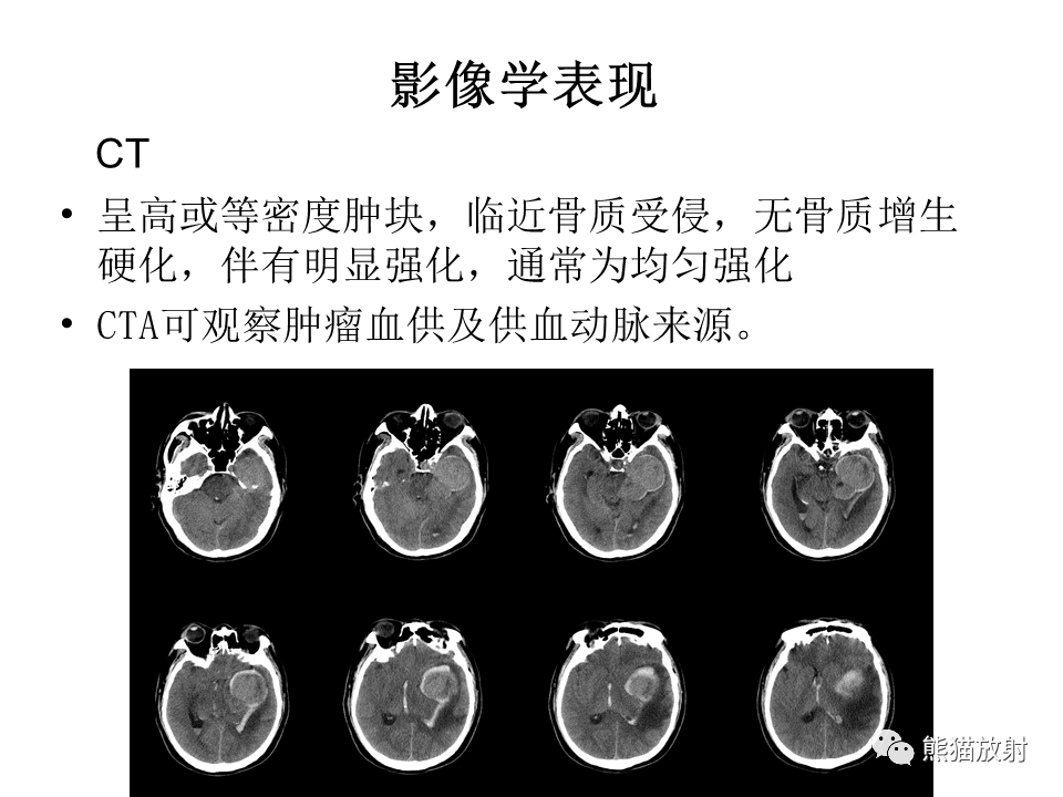 影像PPT - 【病例】脑膜瘤 VS 孤立性纤维瘤-45