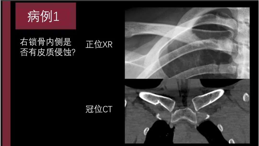 影像PPT - 【PPT】胸骨与胸锁关节-9