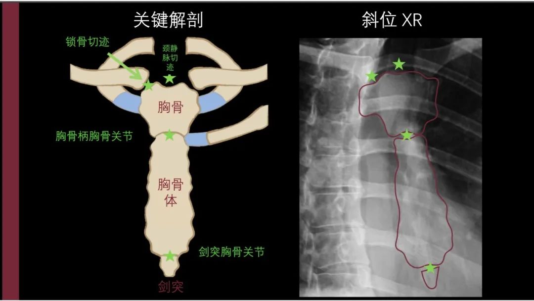 影像PPT - 【PPT】胸骨与胸锁关节-4
