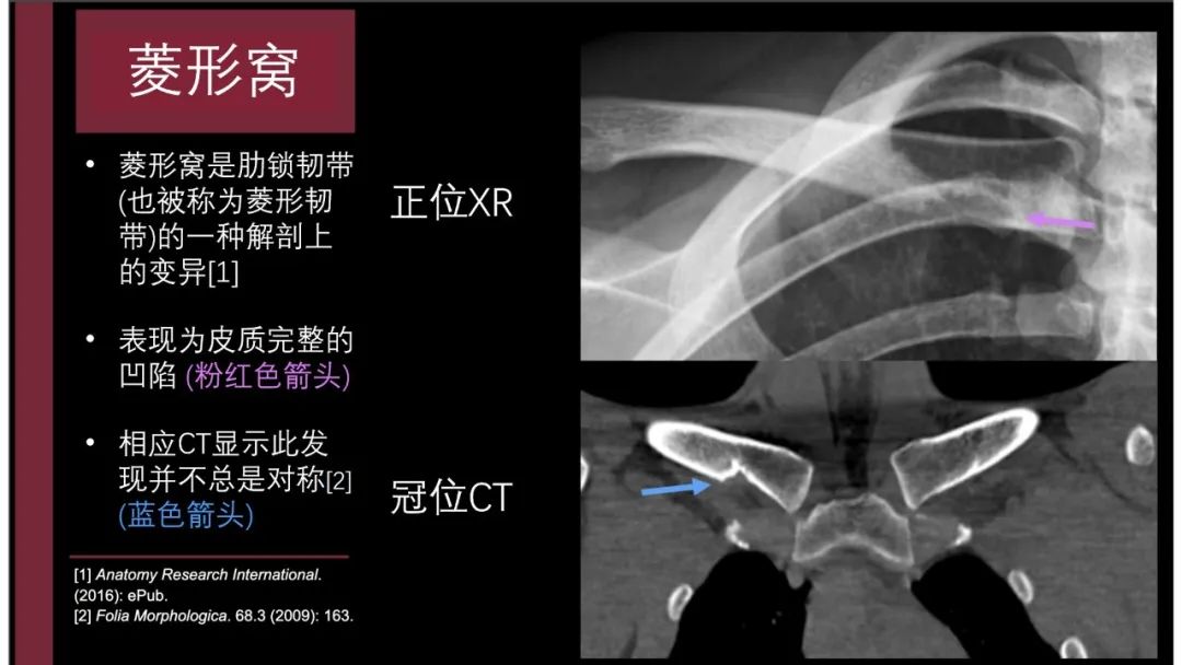 影像PPT - 【PPT】胸骨与胸锁关节-10