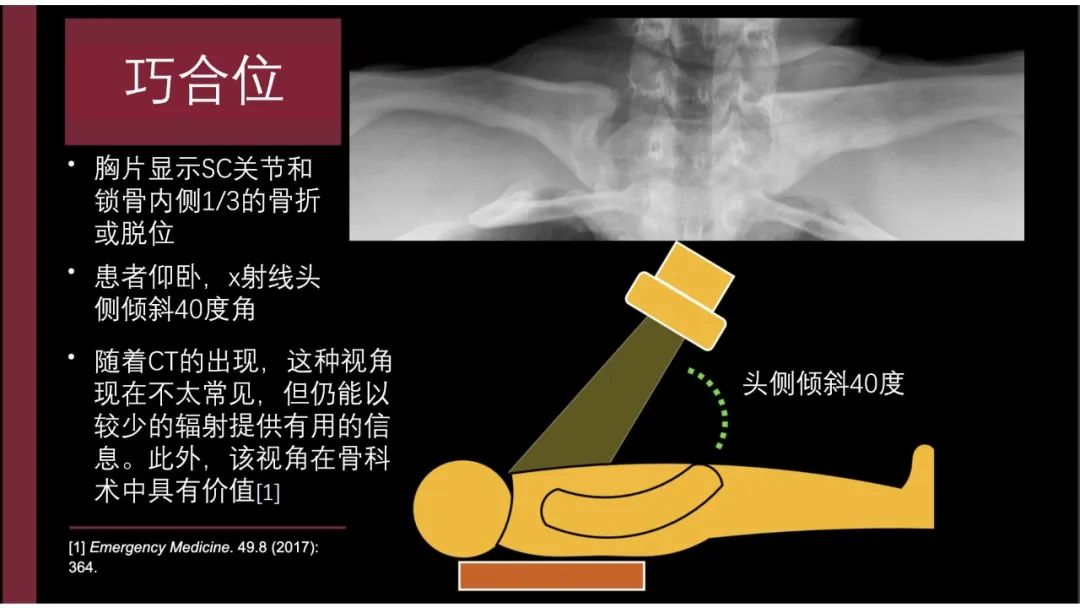 影像PPT - 【PPT】胸骨与胸锁关节-7