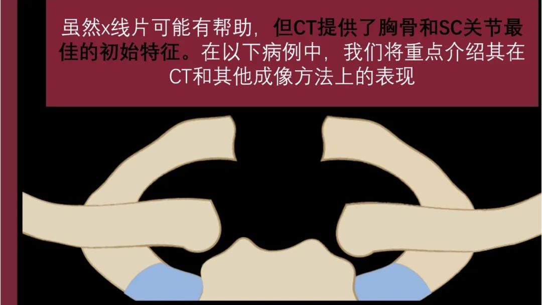 影像PPT - 【PPT】胸骨与胸锁关节-8