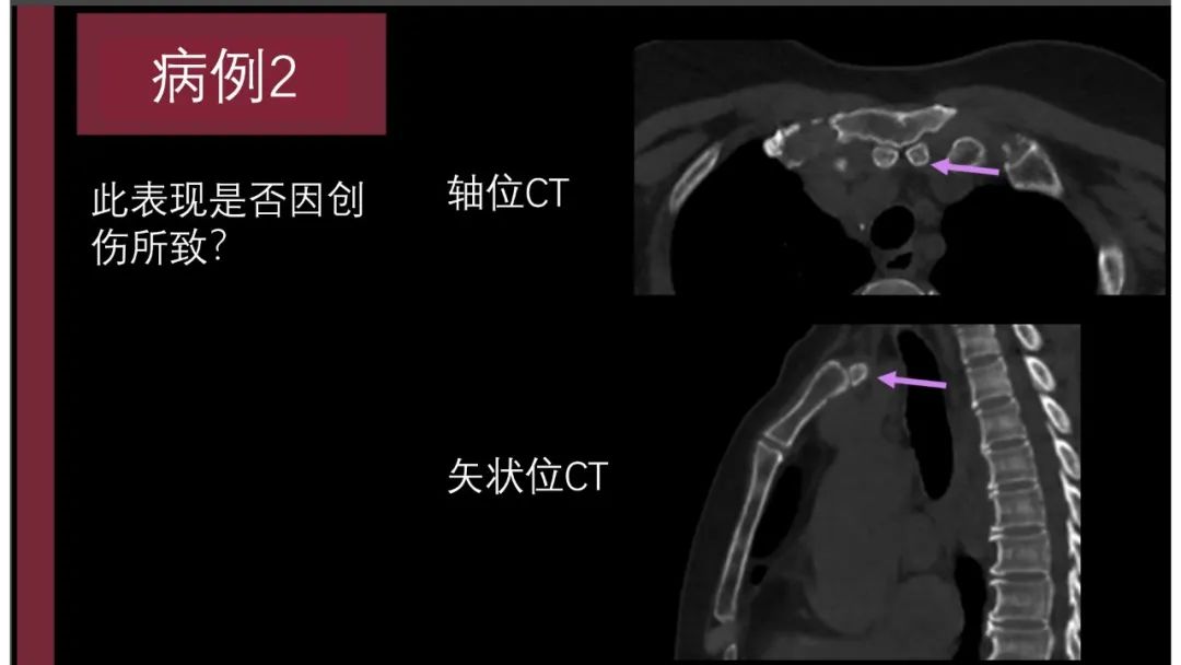 影像PPT - 【PPT】胸骨与胸锁关节-11
