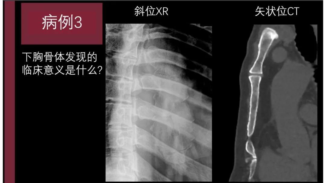 影像PPT - 【PPT】胸骨与胸锁关节-13