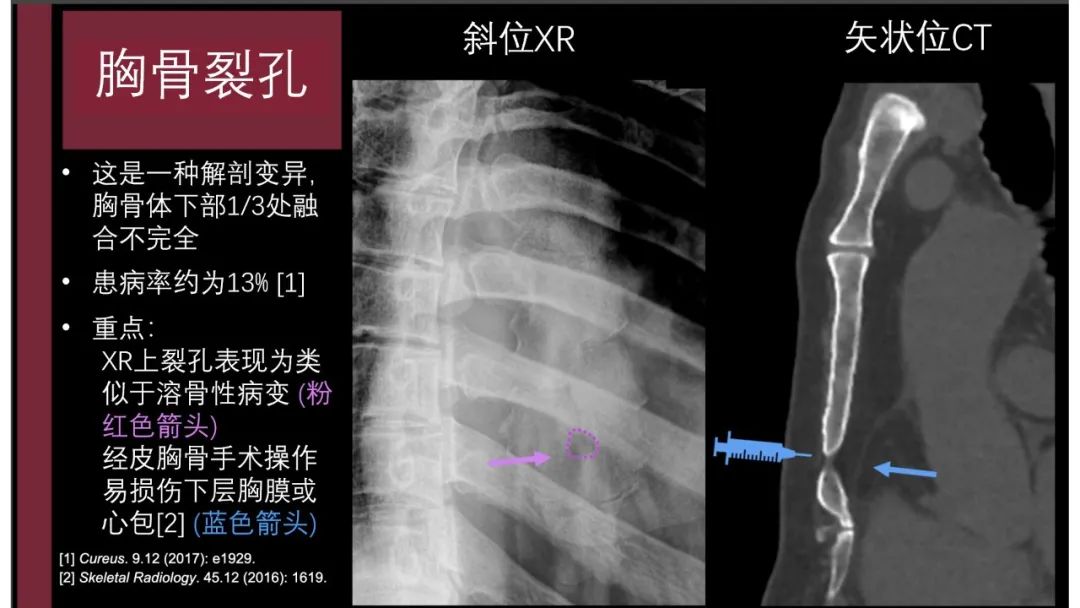 影像PPT - 【PPT】胸骨与胸锁关节-14