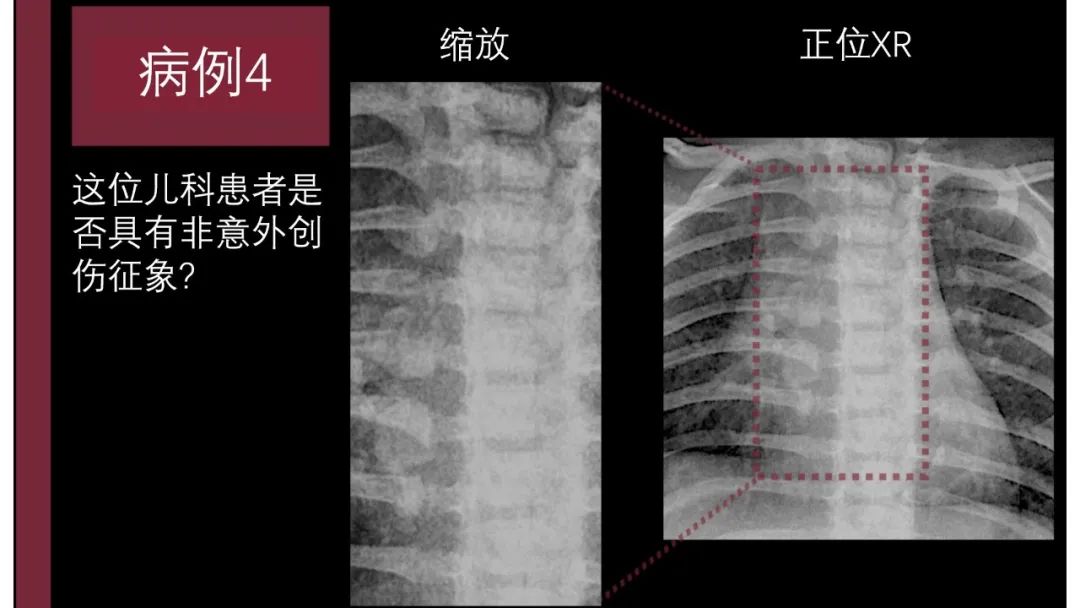 影像PPT - 【PPT】胸骨与胸锁关节-15