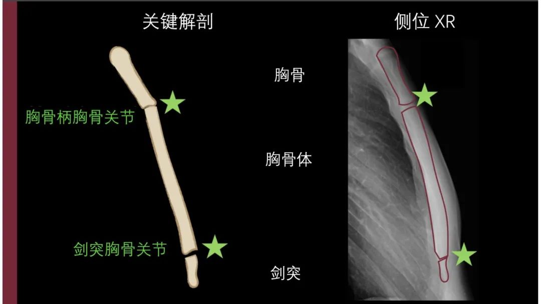 影像PPT - 【PPT】胸骨与胸锁关节-6