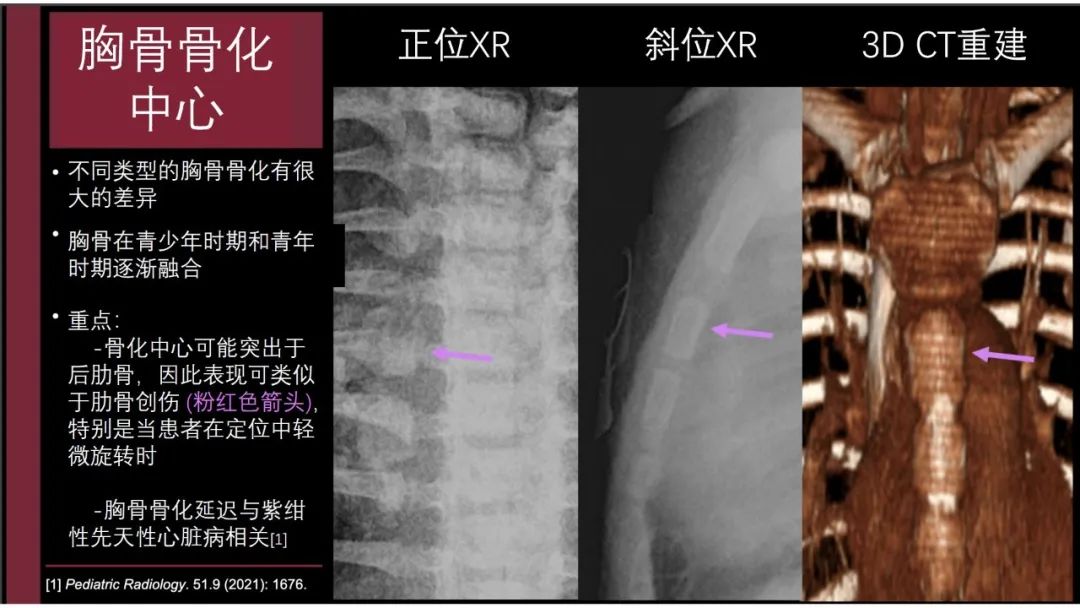 影像PPT - 【PPT】胸骨与胸锁关节-16