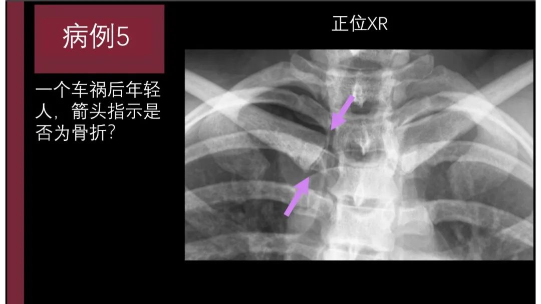 影像PPT - 【PPT】胸骨与胸锁关节-17