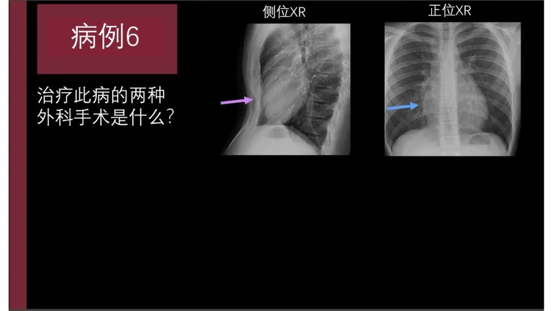 影像PPT - 【PPT】胸骨与胸锁关节-19
