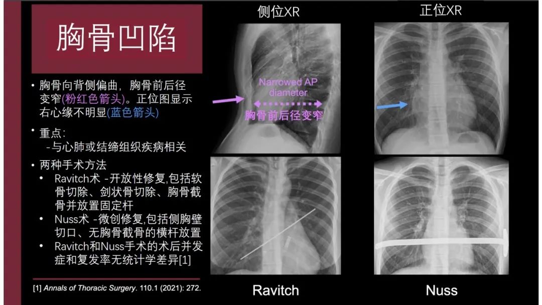影像PPT - 【PPT】胸骨与胸锁关节-20
